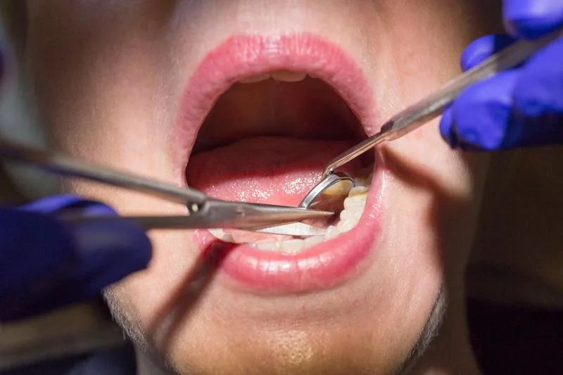 Scoaterea firelor după implant dentar. Când se face, cum decurge la cabinet și ce urmărești în zilele de vindecare