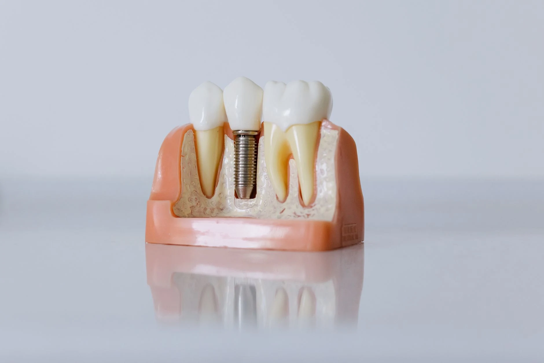 Infecție implant dentar. Cum o recunoști la timp și ce tratament îți salvează implantul
