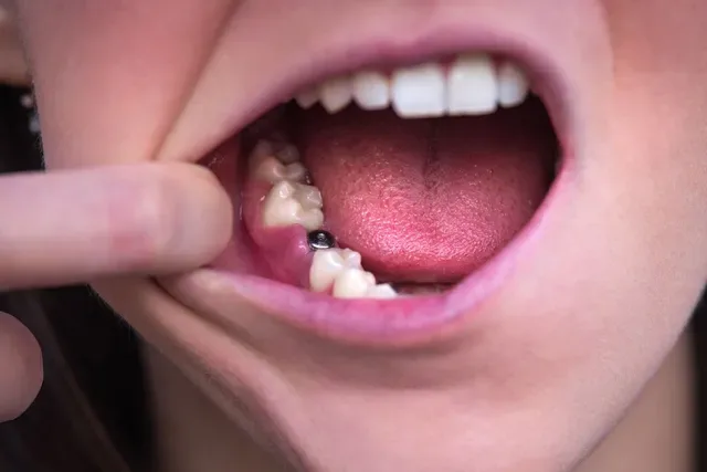 Cât persistă durerea după implant dentar și cum îți dai seama când disconfortul nu mai este normal