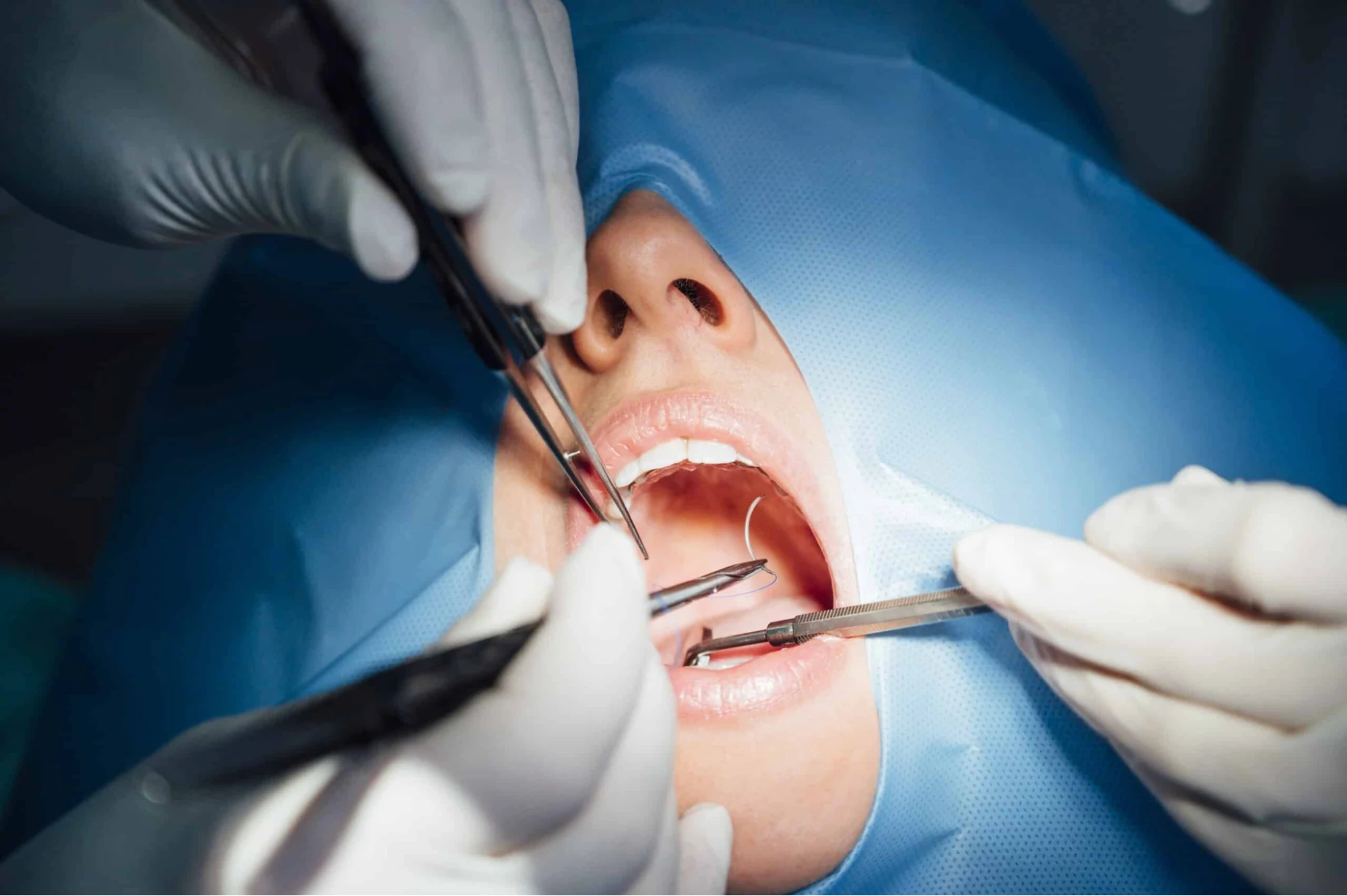 Etapele unui implant dentar explicate pas cu pas, de la prima consultație până la coroana definitivă